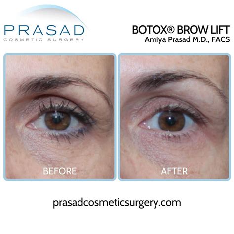 Brow Lift Before And After Photos Manhattan And Long Island, 51% OFF