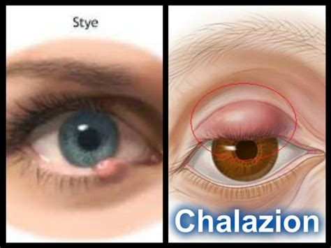 hordeolum vs chalazion - pictures, photos