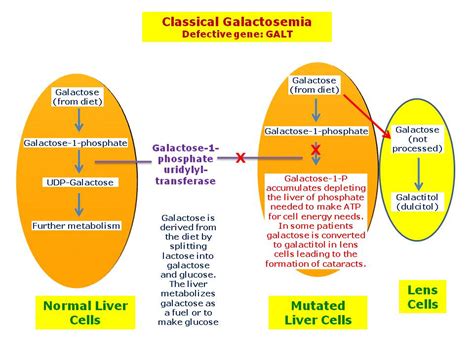 Galactosemia | Hereditary Ocular Diseases