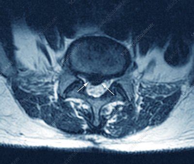 'Herniated spinal disc, MRI scan' - Stock Image - C002/6528 - Science Photo Library