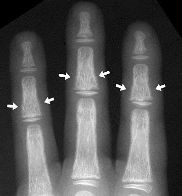 Osteopenia