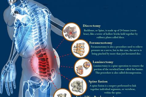 Spine Surgery – Types of Spine Surgery – Boston Neurosurgery