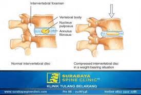 HNP, Saraf Terjepit Pada Tulang Belakang - Klinik Saraf Kejepit Tulang Belakang Siloam Hospitals ...