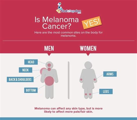 Melanoma: Symptoms, Causes, Treatment, and Diagnosis | FindATopDoc