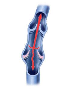 3 Varicocele Complications and Their Symptoms | Azura Vascular Care