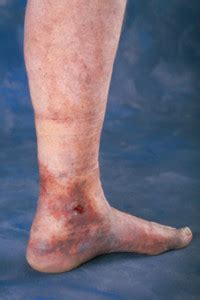 Bleeding Varicose Veins - Top Varicose Vein Treatment NYC