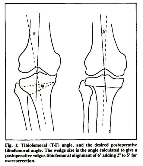 Lateral Tibial Plateau Fracture as a Postoperative Complication of High Tibial Osteotomy