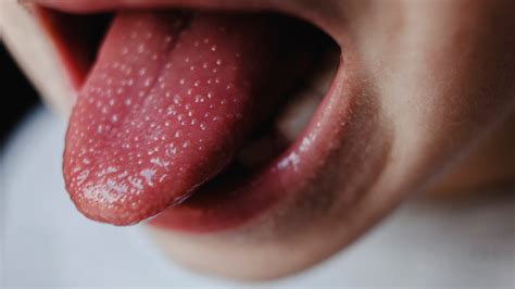 Big Tongue (Macroglossia) Symptoms, Causes, and Treatment