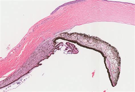 Eye – Iris and Ciliary body – NUS Pathweb :: NUS Pathweb