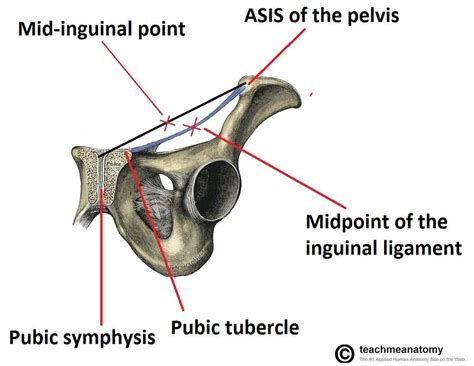 Indirect Inguinal Hernia Anatomy