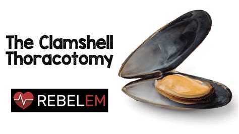 Clamshell Thoracotomy - REBEL EM - Emergency Medicine Blog