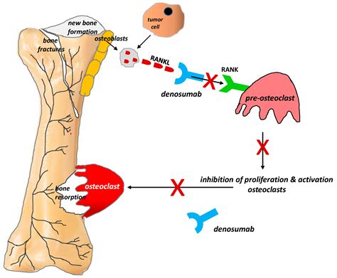 IJMS | Free Full-Text | Bone Pain in Cancer Patients: Mechanisms and Current Treatment