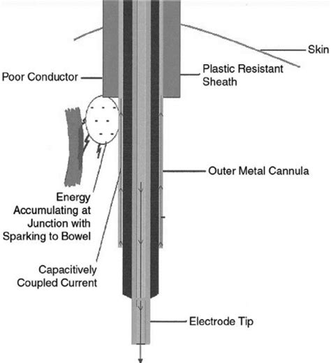 Capacitive Coupling. A capacitively coupled current typically returns ...