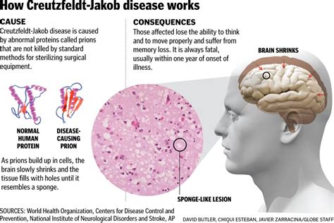 Dr. James Hill, MD points us to the prion (CJD) aspect of the ...