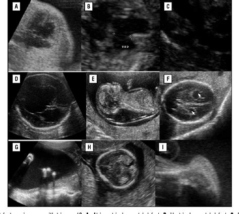 Figure 1 from Ultrasound in Trisomy 18 and 13 | Semantic Scholar