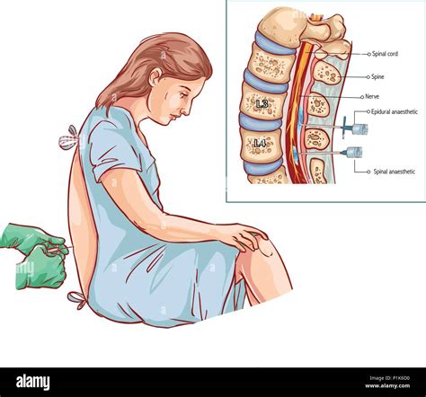 Epidural Nerve Block Banque d'image et photos - Alamy