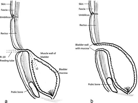 Vesico-cutaneous fistula: A simple method for continent urinary ...