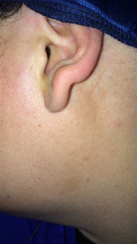 Keloid Removal, scar, skin growth, skin cancer, bcc, mole