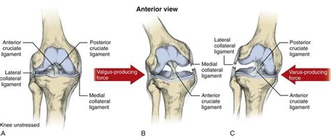 Ligament Sprain