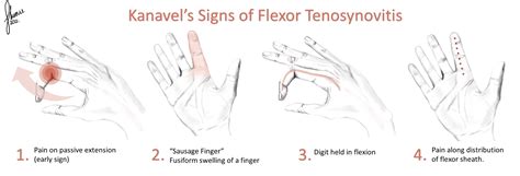 Infectious Flexor Tenosynovitis