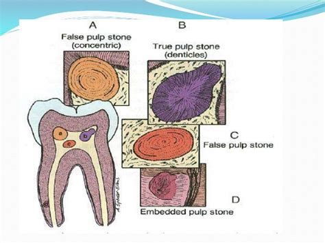 Pulp Diseases a inner discomfort.. | Dr. Nechupadam Dental Clinic