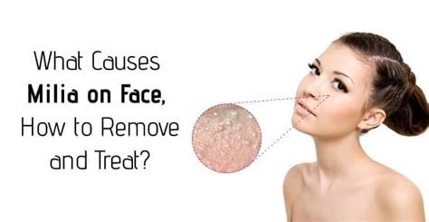 What Causes Milia on Face, How to Remove and Treat?