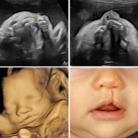 Unilateral cleft lip and palate, visualized on ultrasound during the... | Download Scientific ...