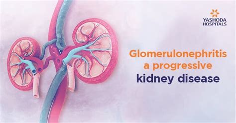 Glomerulonephritis Is Associated With All of the Following Except - Amiah-has-Pollard