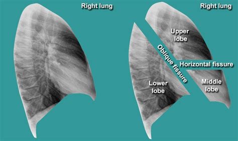 Lung Lobes