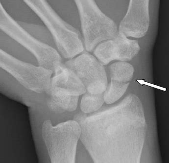 Scaphoid fractures | CUH