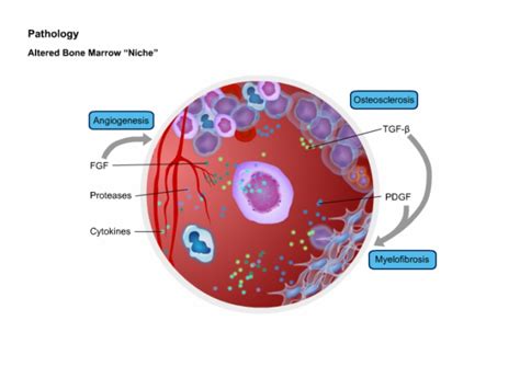 Myelofibrosis