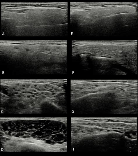 Parotid Gland Ultrasound Measurement