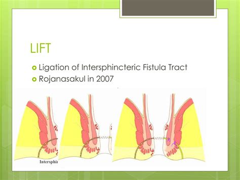 PPT - The Best Surgical Treatment for Fistula-in-ano PowerPoint Presentation - ID:767705