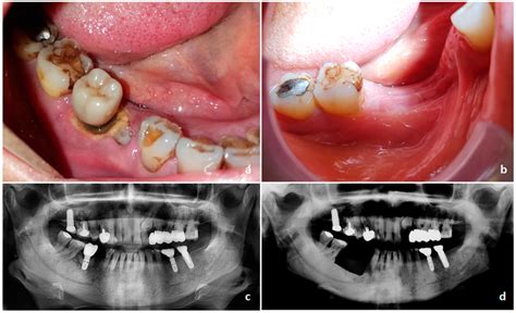 Osteonecrosis In The Jaw