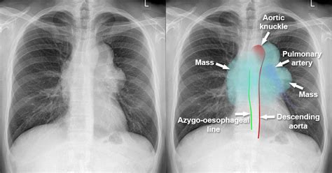 Chest X-ray - Mediastinum and hilum - Anterior mediastinal mass