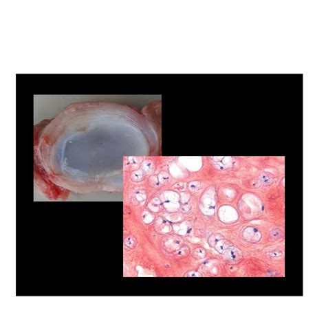 Intervertebral Disc