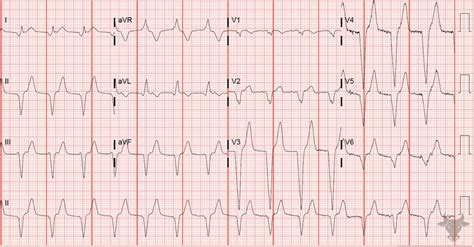 Accelerated Idioventricular Rhythm | ECG Stampede