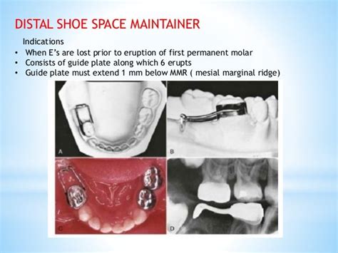 DISTAL SHOE SPACE MAINTAINER PDF