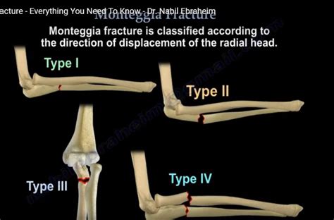 Monteggia Fractures of the Forearm — OrthopaedicPrinciples.com