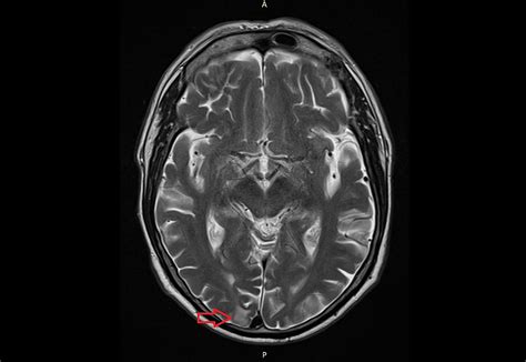 Cureus | A Suspected Vestibular Schwannoma with Uncharacteristic Growth Dynamic and Symptom ...