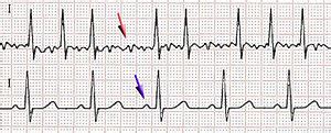 Atrial Fibrillation - WikiLectures