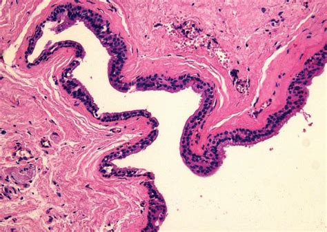 Globulomaxillary Cyst Histology