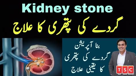 Kidney stone homeopathic medicine | Kidney stone pain relief | Kidney stone symptoms & treatment ...