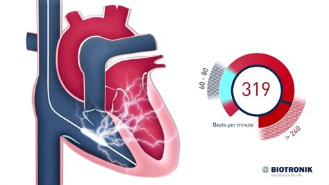 Implantable Cardioverter Defibrillator - ICD - Therapy (Movie 6 BIOTRONIK) - YouTube