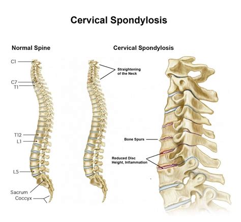 Cervical Spondylosis Treatment in Fairfax, VA and Potomac, MD | Spine and Pain Clinic of North ...