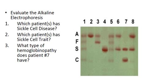 Hemoglobin Sc Disease Electrophoresis - Pregnancy Depression