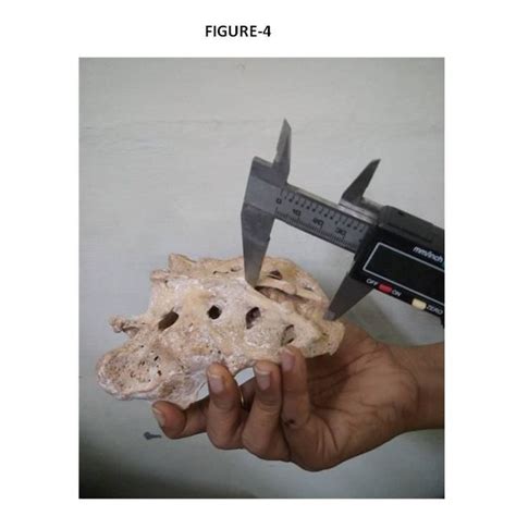 Measurement of length of sacral hiatus (from apex to base). | Download ...