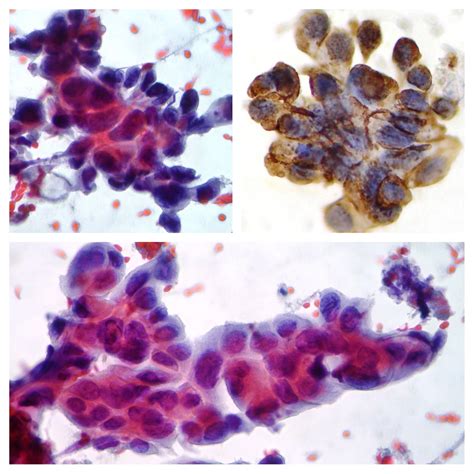 Cytopathology of lymph nodes-FNAC – Cellnetpathology.com