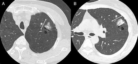 Findings of peripheral lung cancer on thin-section CT (A), (B); a:... | Download Scientific Diagram