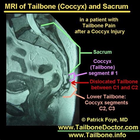 Tailbone MRI: coccyx dislocation, Tailbone Pain | Tailbone M… | Flickr